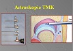 Artroskopie temporomandibulárního kloubu